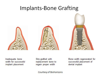 Bone Grafting and Sinus Lifts - Tony Kim Dental