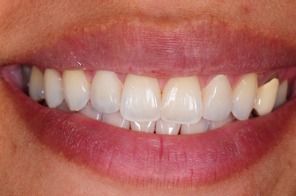 Laser teeth whitening hawaii